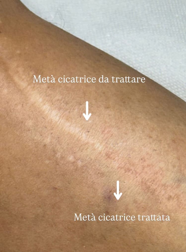 Copertura cicatrici e smagliature - es. 01