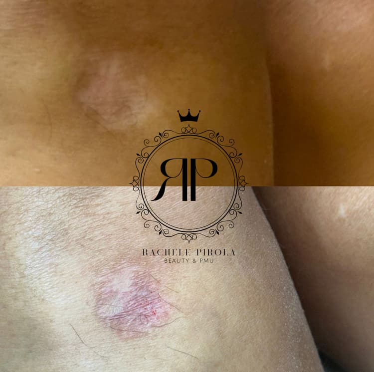 Copertura cicatrici e smagliature - es. 11