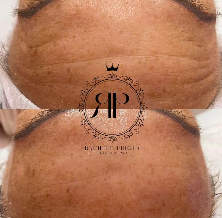 Fili tensori cosmetici - es. 11