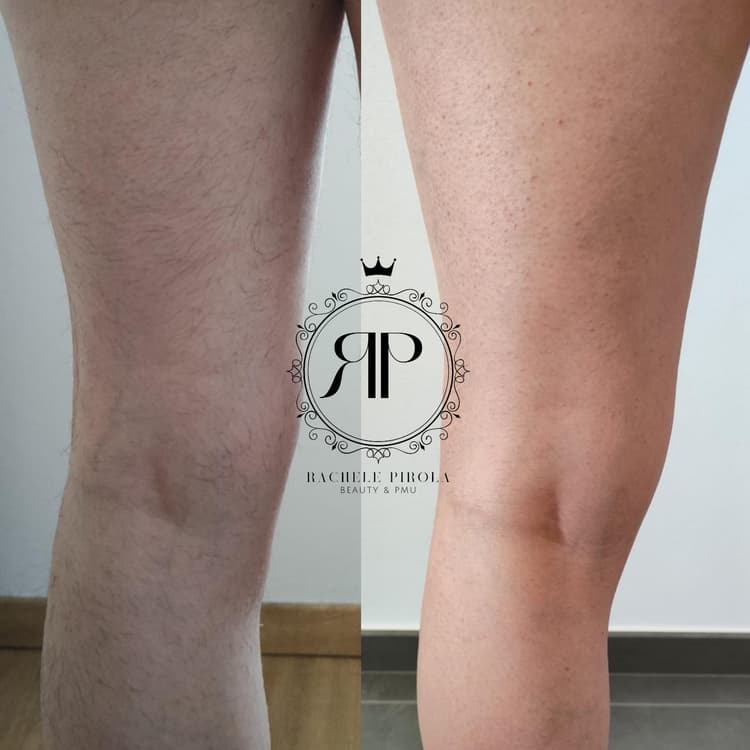 Laser per epilazione definitiva - es. 01