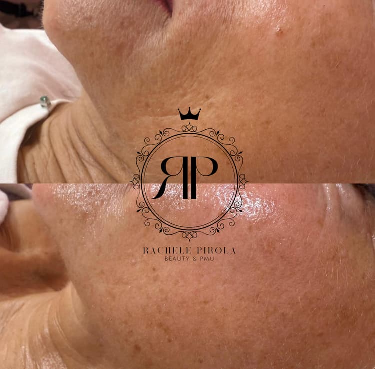 Peeling chimici - es. 01