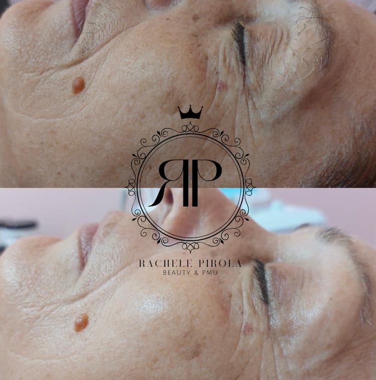 Pulizia profonda Hydra - es. 01